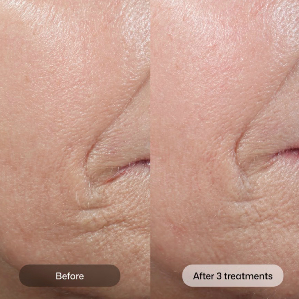 D.E.J. BioStem at Arosa Aesthetics in Reno, NV