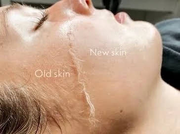 Dermaplaning Service