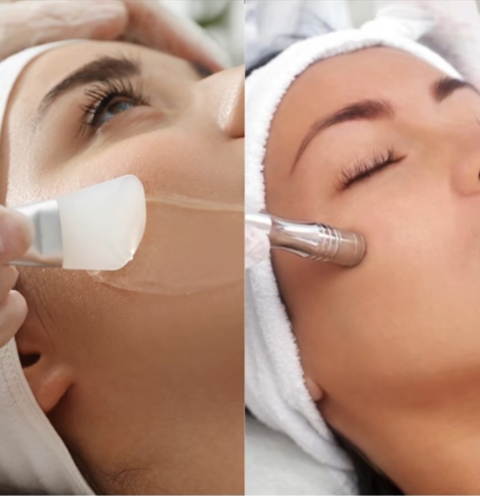 Microdermabrasion W/ Chemical Peel