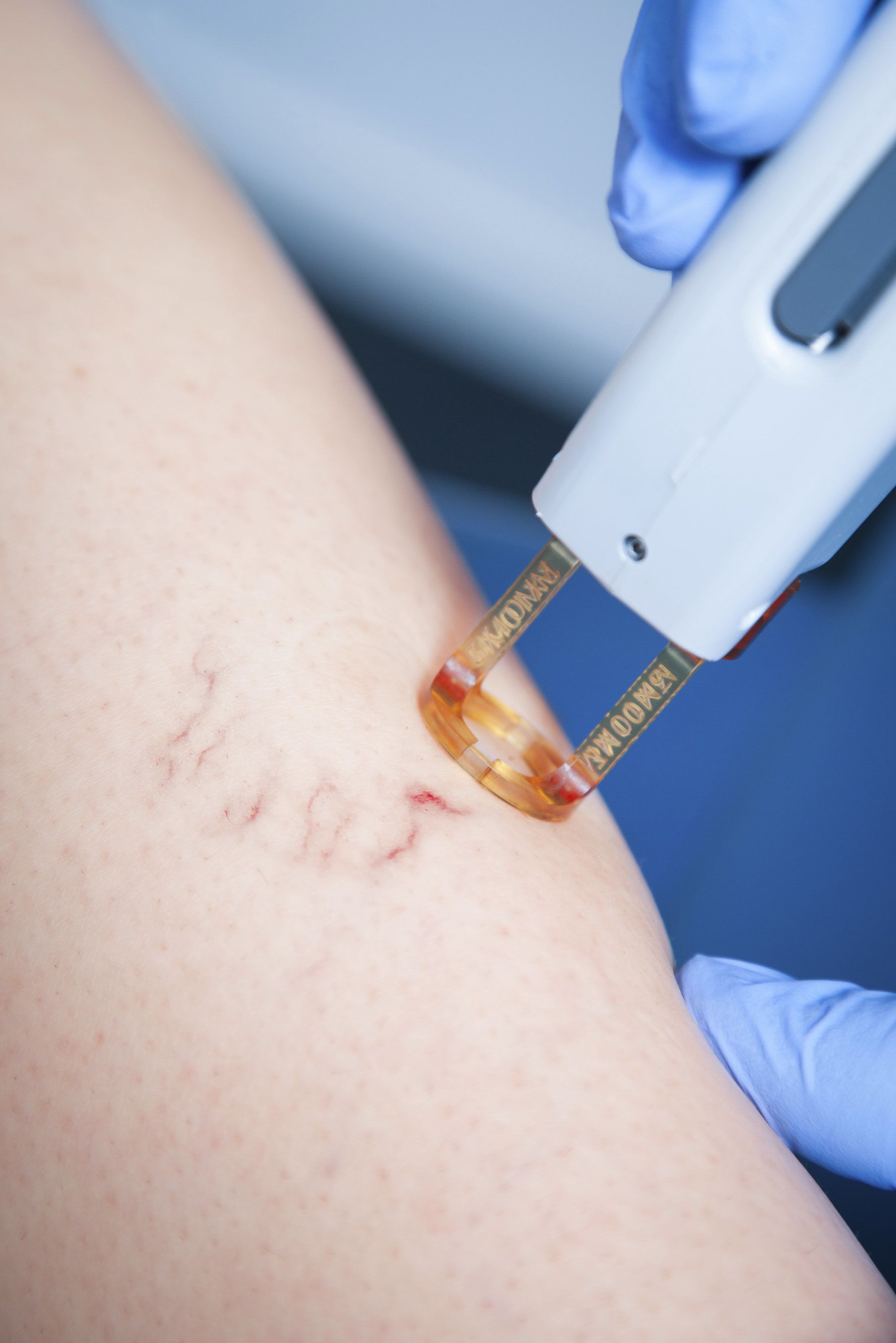 Laser Vein Removal