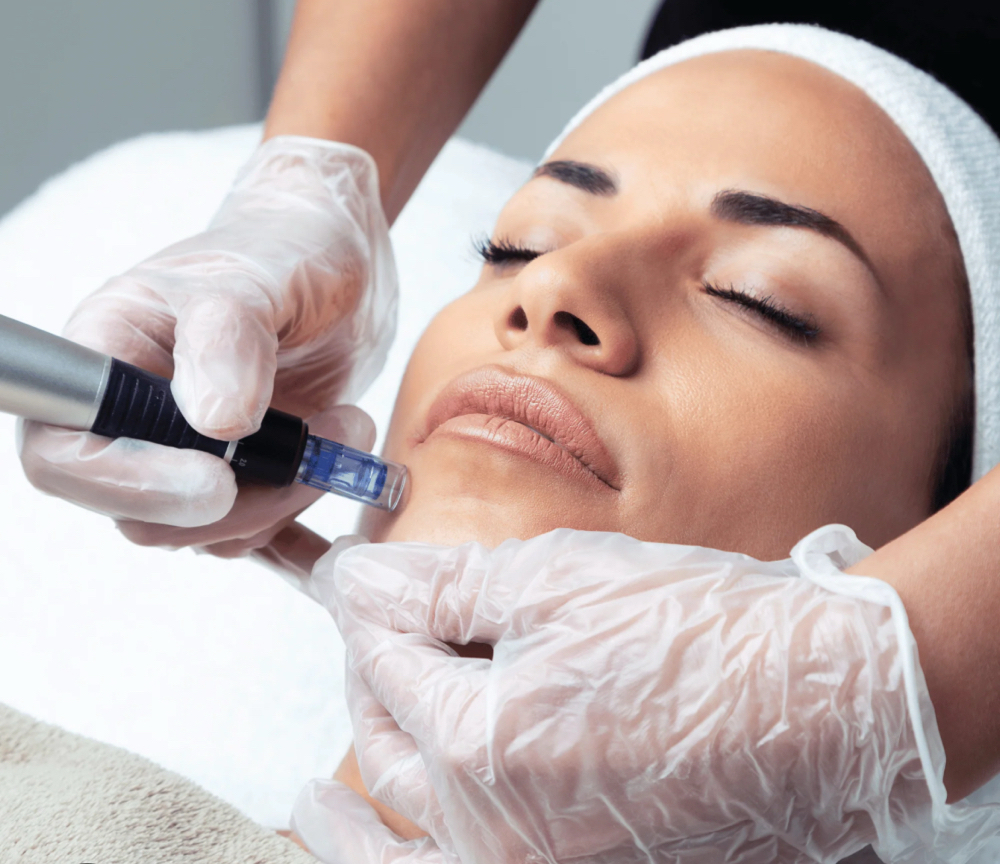Microneedling at Ultimate Skin Care in Flanders, NJ