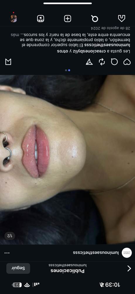 1.5ML LIP FILLER at Glow Esthetic NY in Buffalo, NY