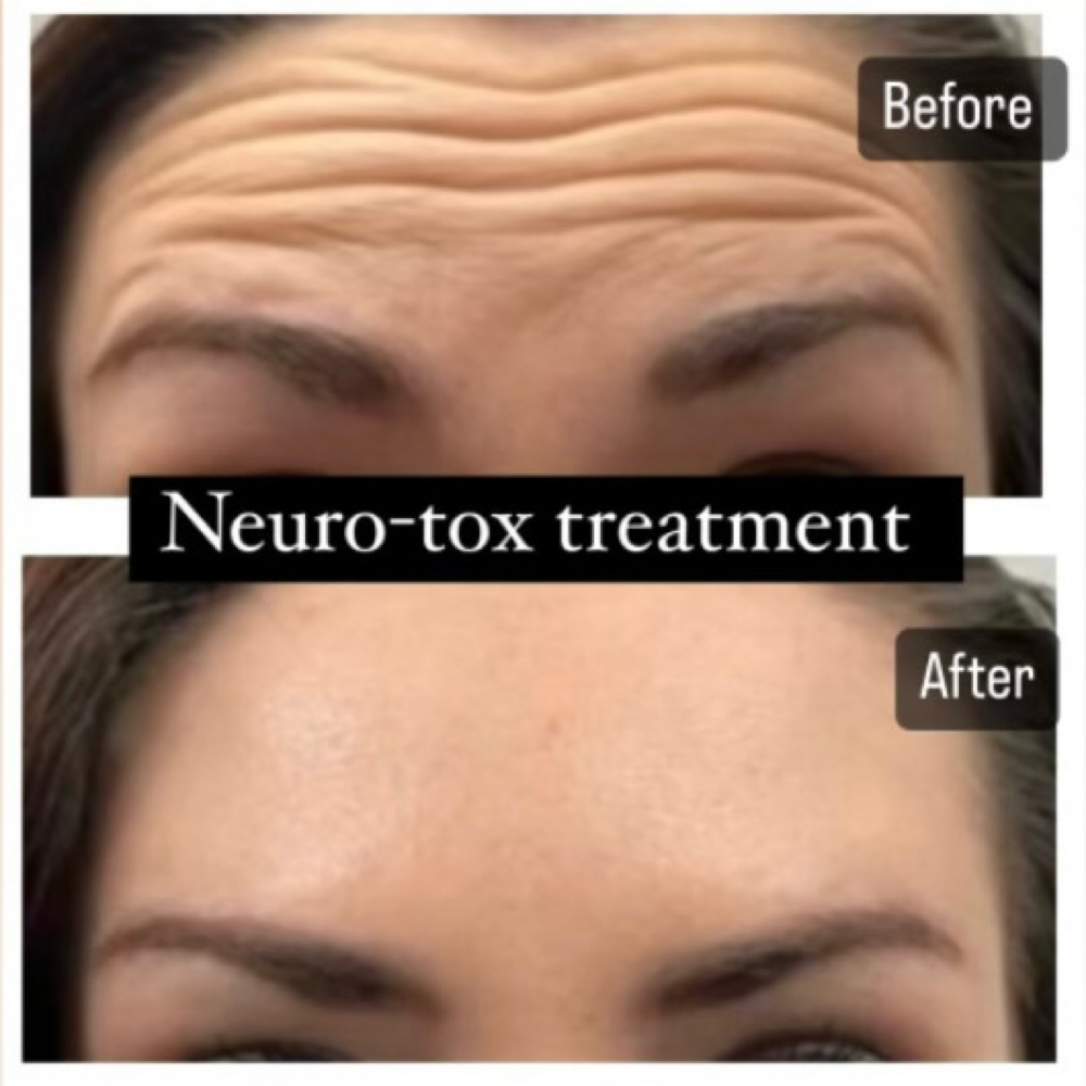 Wrinkle Tox at Holistic Beauty in View On Website, NY