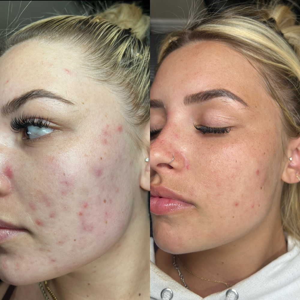 Microneedling Facial