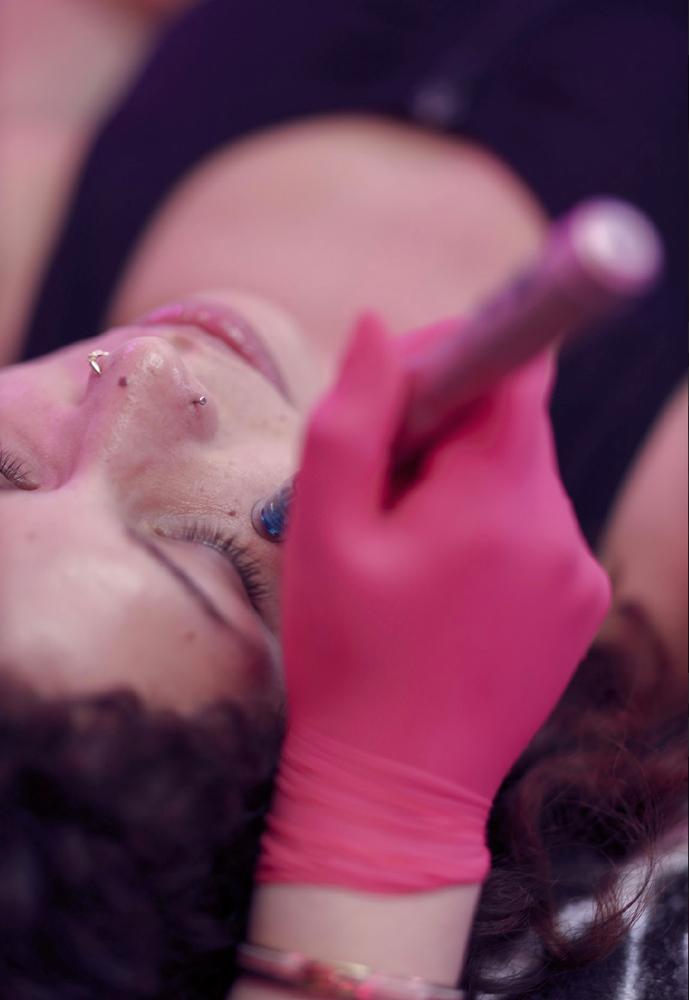 Microneedling