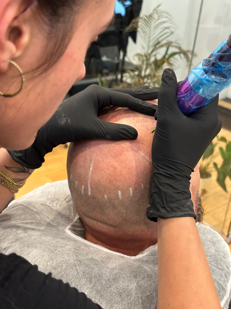 SCALP MICROPIGMENTATION Session 2