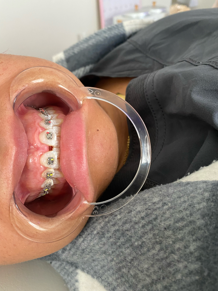 PER Tooth Gem Replacement