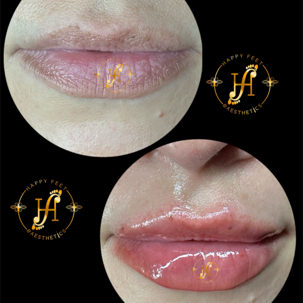 Lip Filler (0.6ml) at Happy Feet & Aesthetics in Plainview, TX