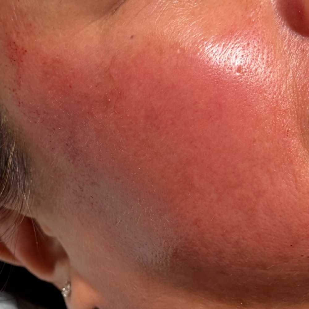 SkinStylus™ Microneedling- OR at Unmasked Aesthetics in Clackamas, OR