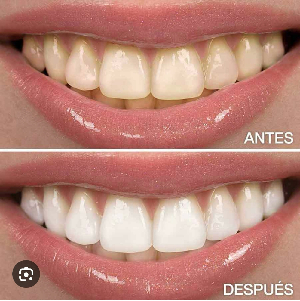 Blanqueamiento Dental at Dream Body Esthetic in Orlando, FL