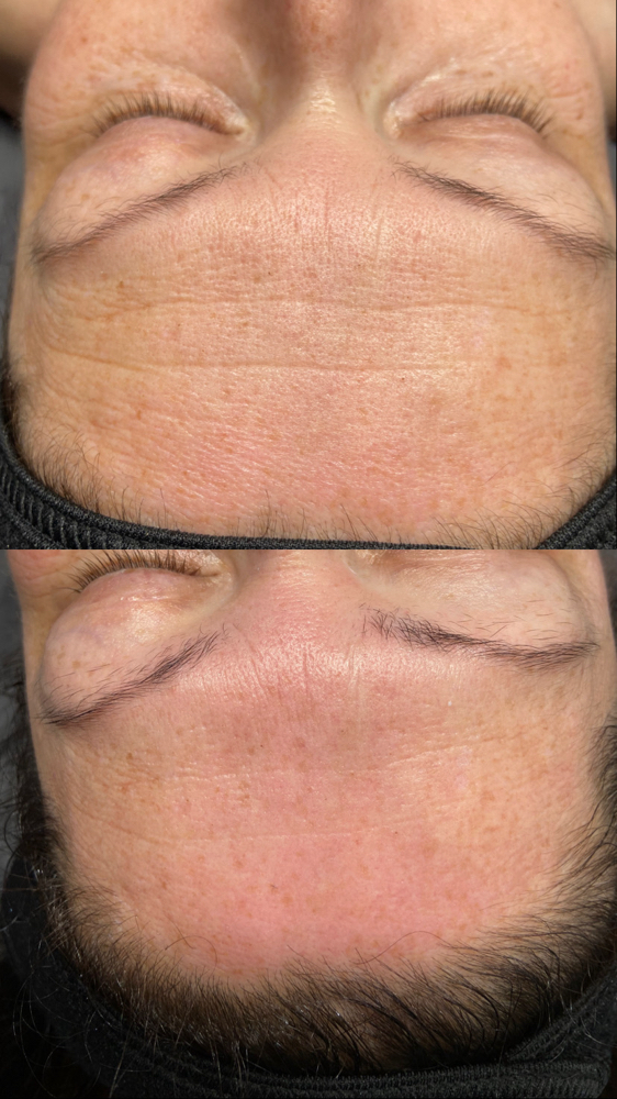 Anti Aging Facial