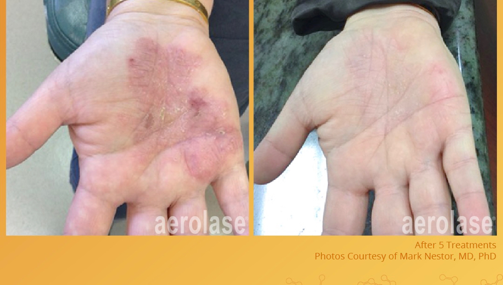 Psoriasis Laser Package