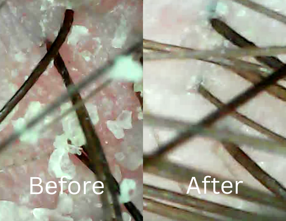 Scalp Scope And Treatment