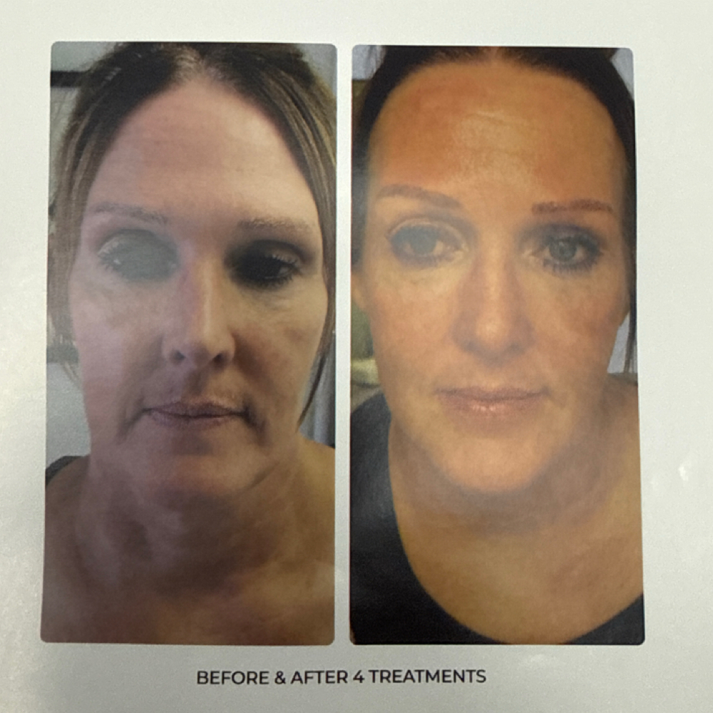 T-Shape 2 Facial Treatments at You…Only Better in Kansas City, MO