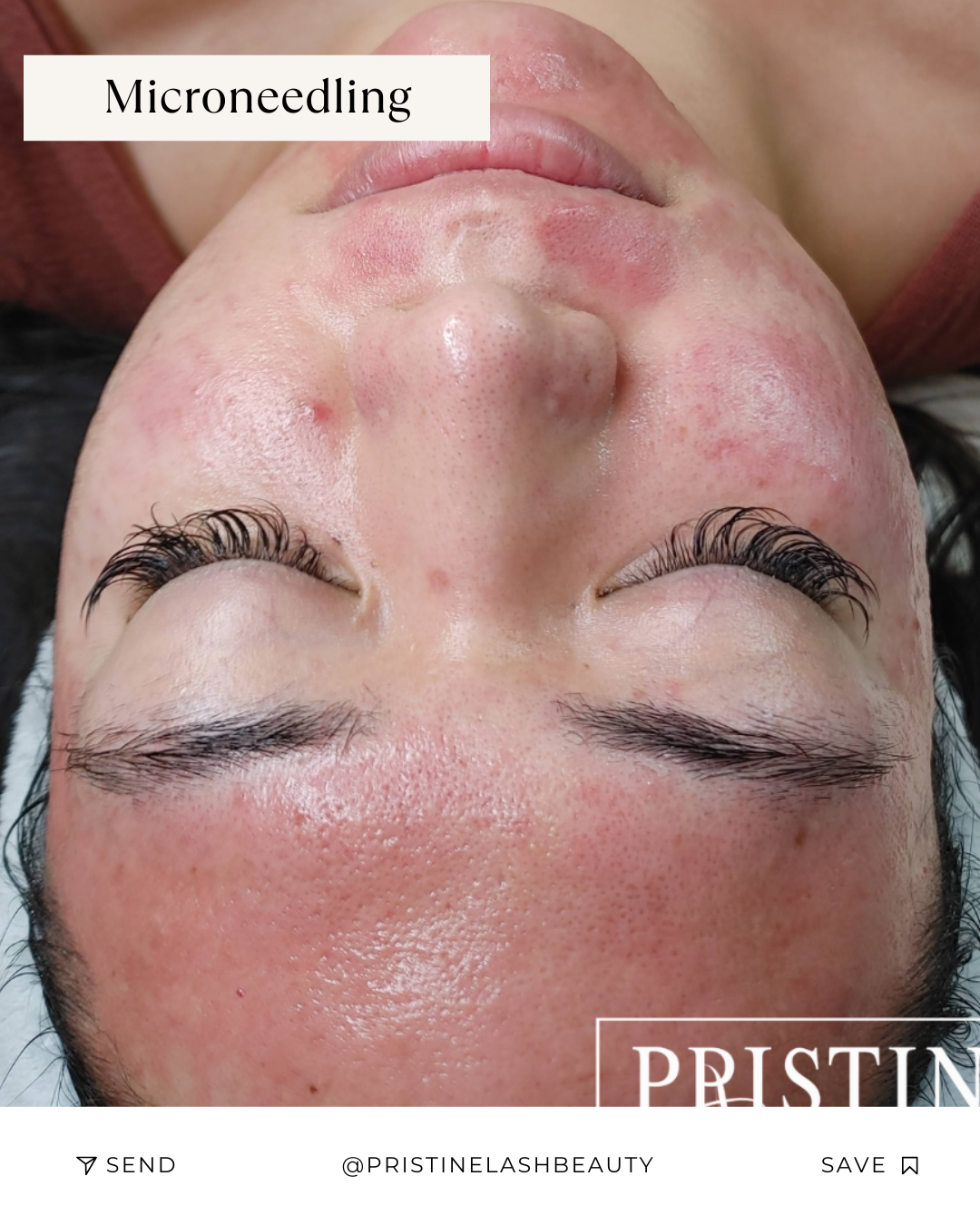 Microneedling Facial