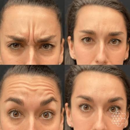 Wrinkle Treatment (Upper Face) Tox at Ultimate Health Spa in Leesburg, FL