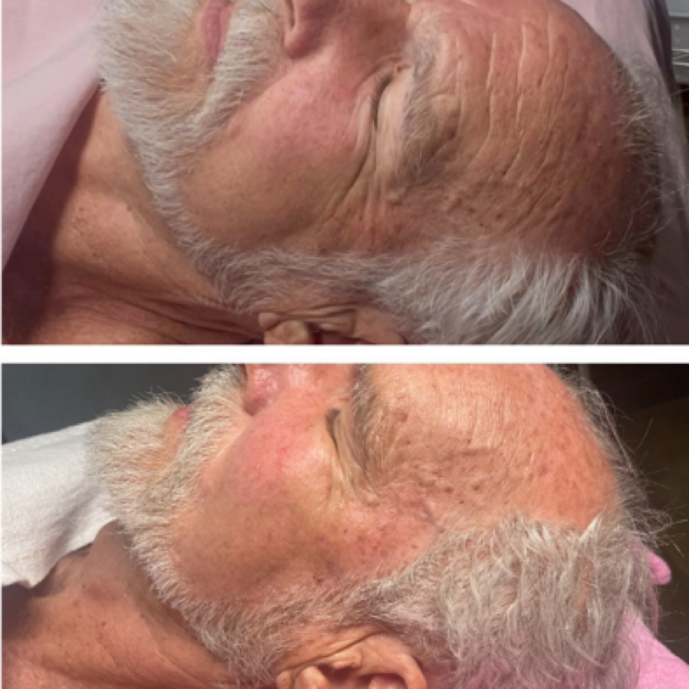 The Renewal Lift Ritual at Rejoovenation in Colorado Springs, CO