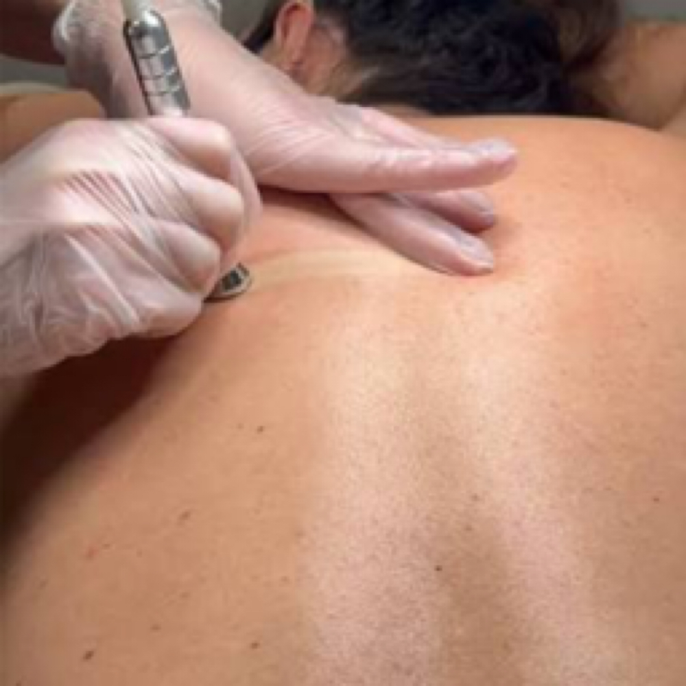 Back Microderm Facial at AK Aesthetics in Downers Grove, IL