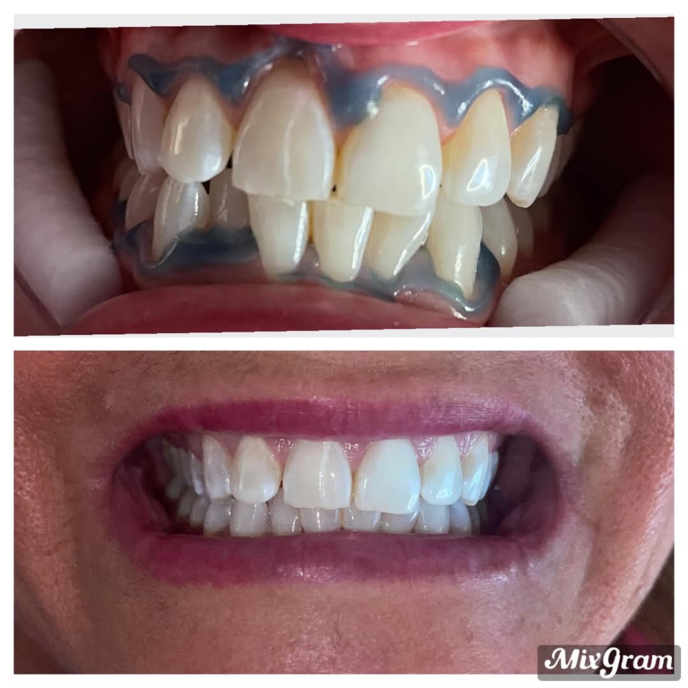 Teeth Whitening