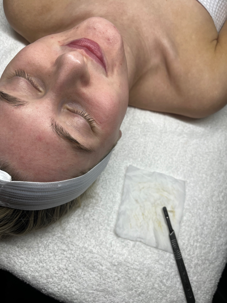 Dermaplane Facial