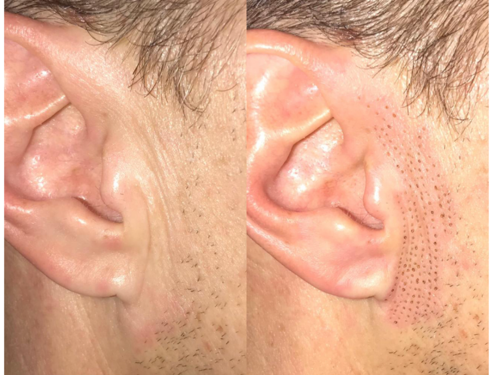 Ear Lobes/ Auricular Region