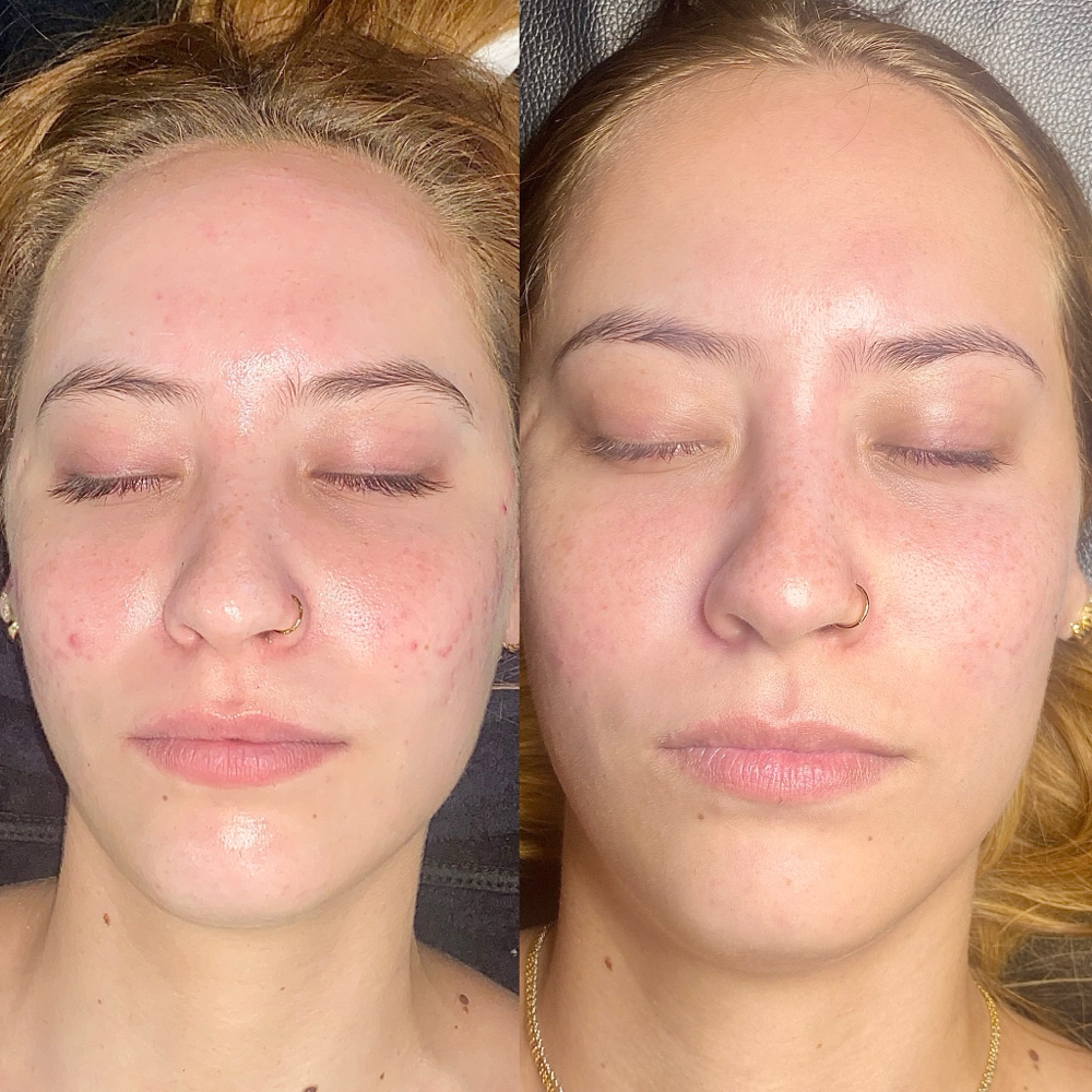 Acne Facial