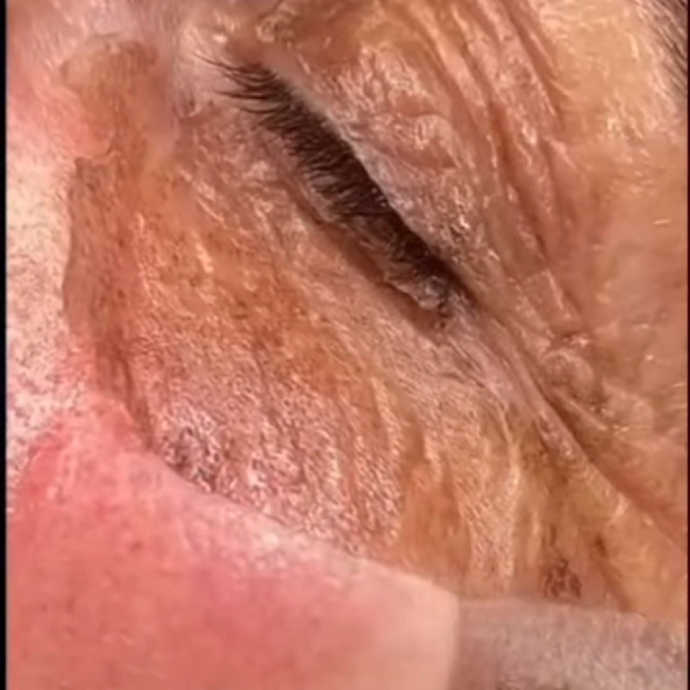 Elaine Brennan Skin Renewel Peel at Miss A Aesthetics in Enid, OK