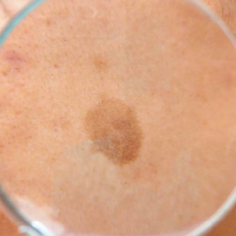 Brown Spots at Bliss Beauty Spa in Thomaston, ME