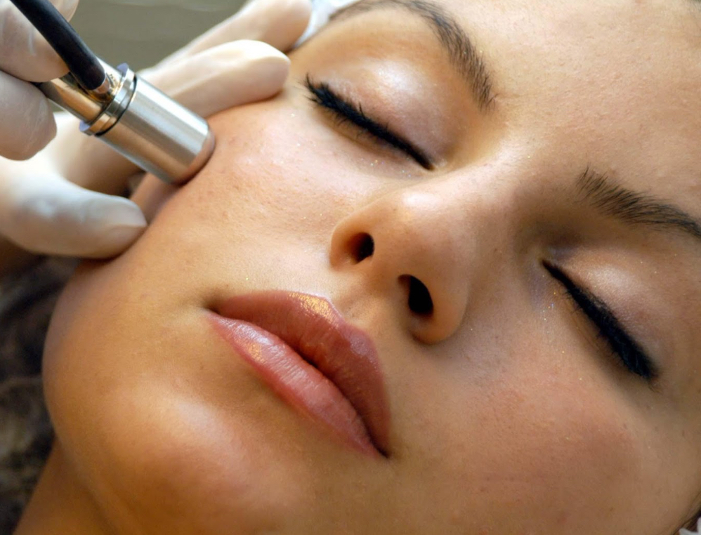 Diamond Microdermabrasion at V Esthetics in Lynn, MA