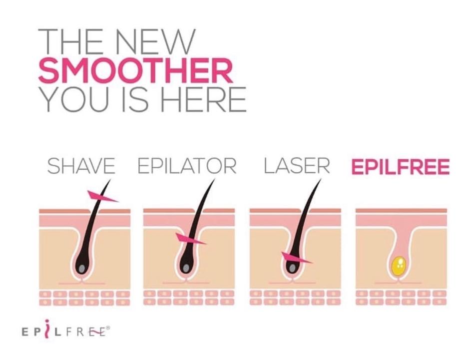 Epilfree permanent hair removal