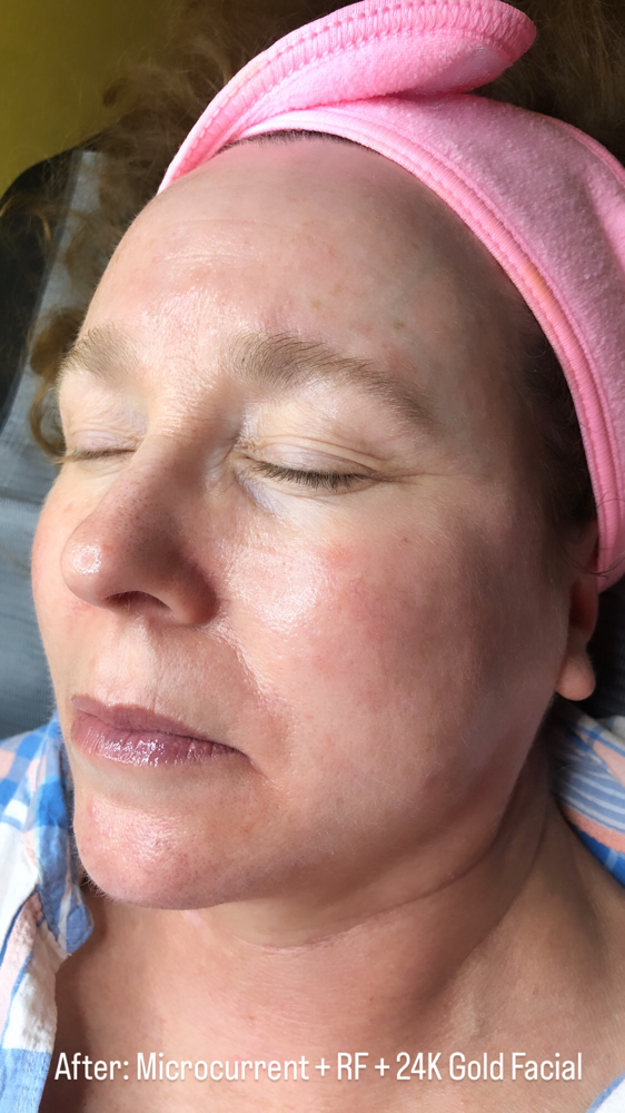 Radio Frequency Facial