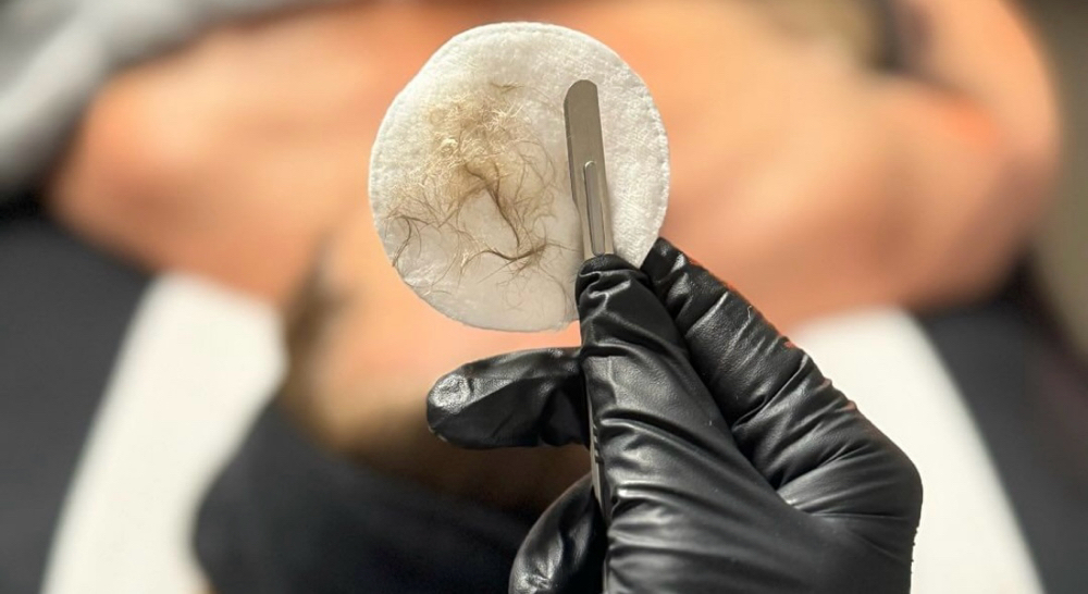 Dermaplaning