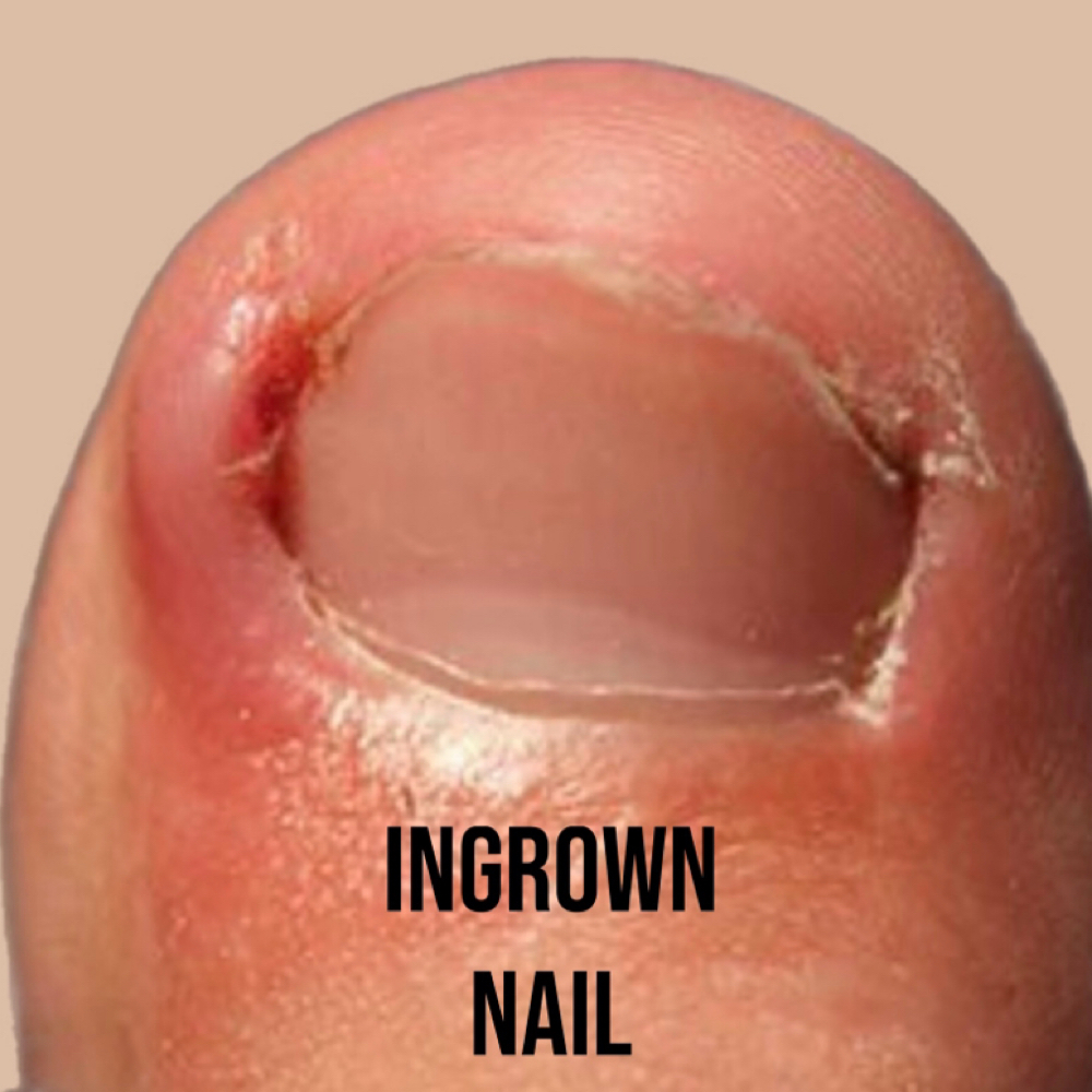 Additional + One Ingrown at Happy Feet & Aesthetics in Plainview, TX