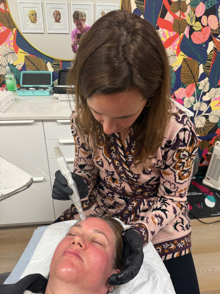 Microneedling