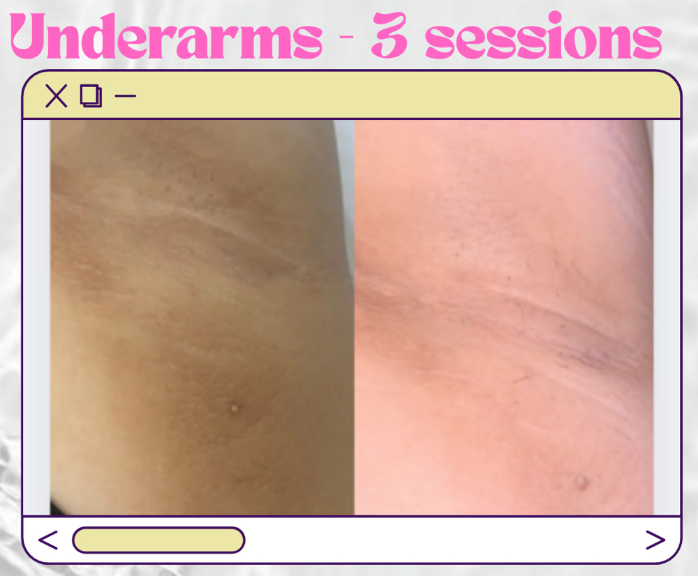 Skin Lightening - Underarms