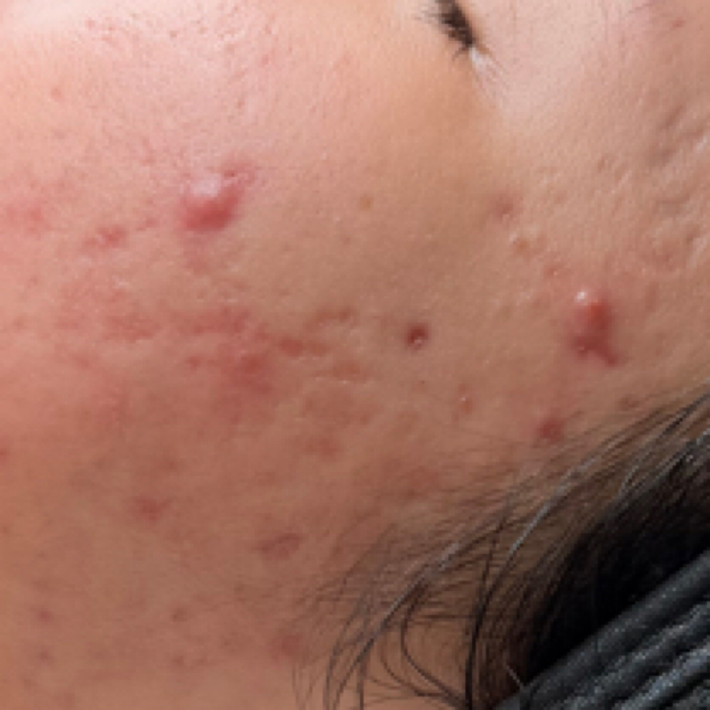 The Reset Acne Treatment at Skin Tonic LLC in Honolulu, HI