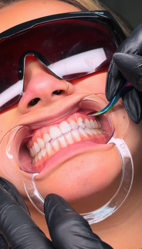 Tooth Gems