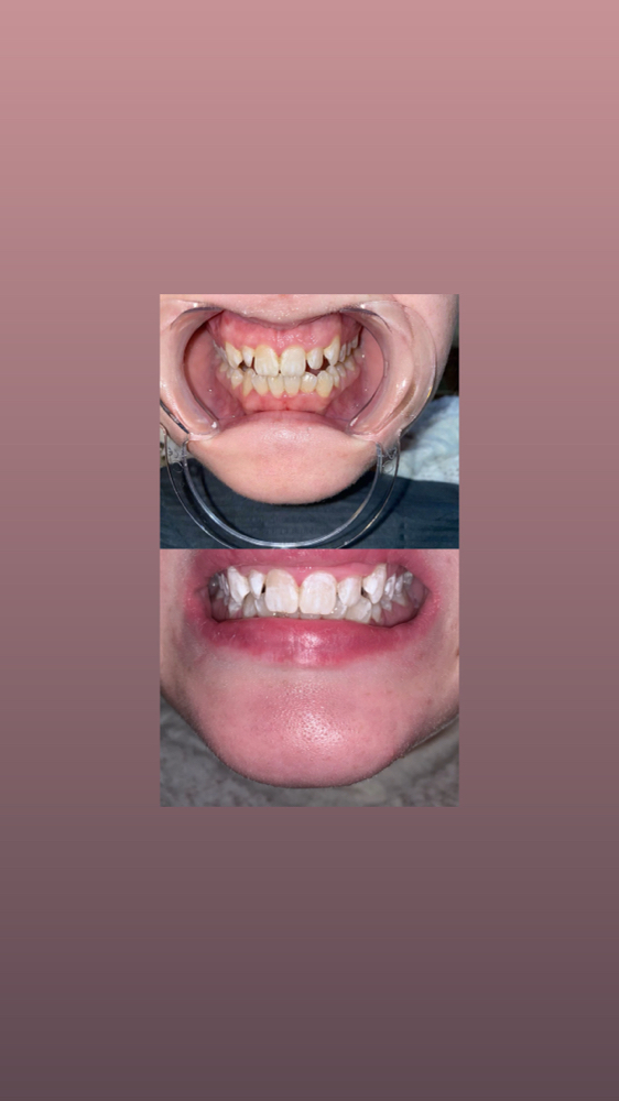 teeth whitening 2 hrs at RJ Cosmetics in PONTOTOC, MS