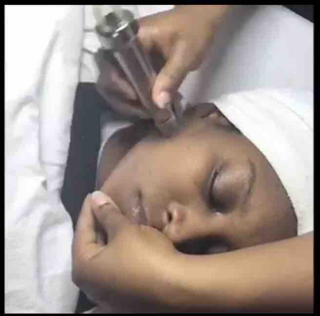 Microdermabrasion