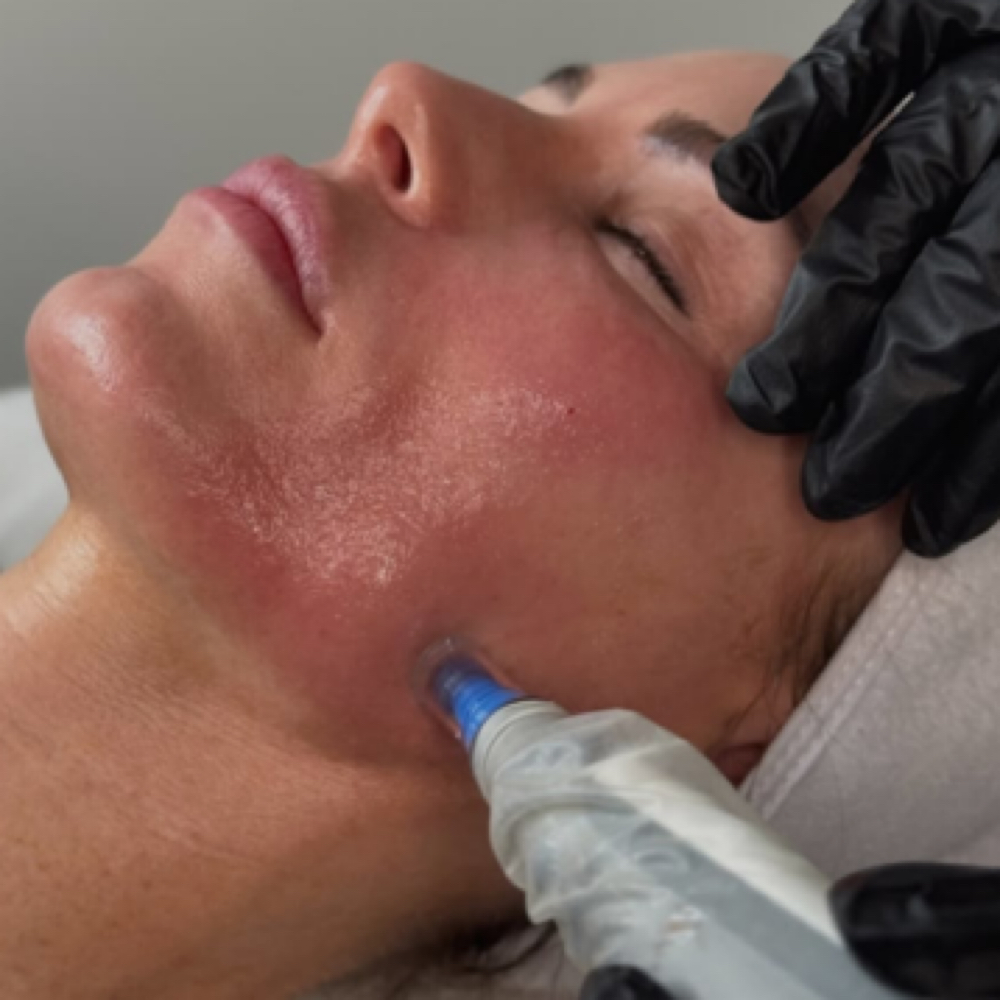 Microneedling at The Bella Angel Glow in Farmingdale, NY