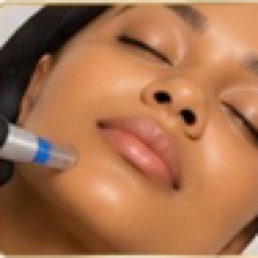 Microneedling with Hyaluronic Acid at Serenity Aesthetics & Spa in Charlotte, NC