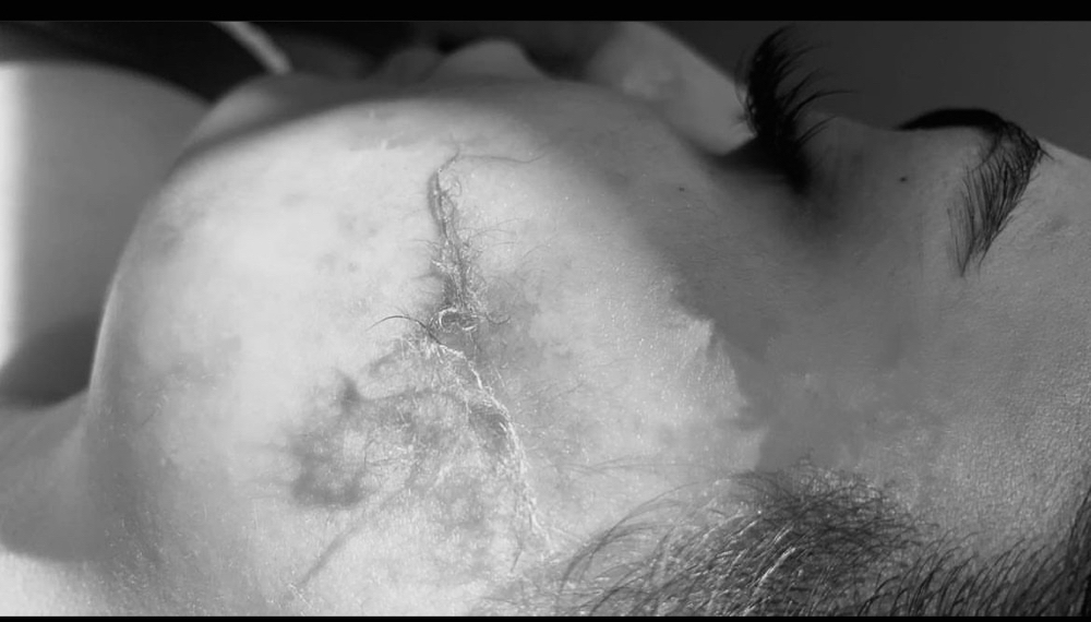 Dermaplane Add On