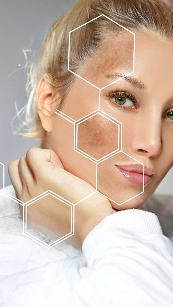 Chemical peel