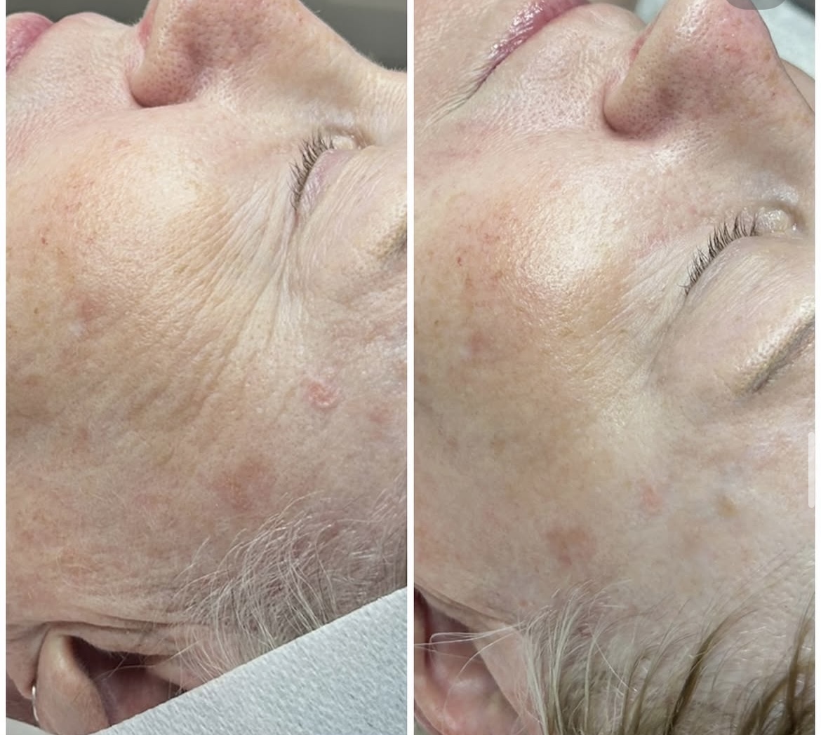 Advanced Customized Facial