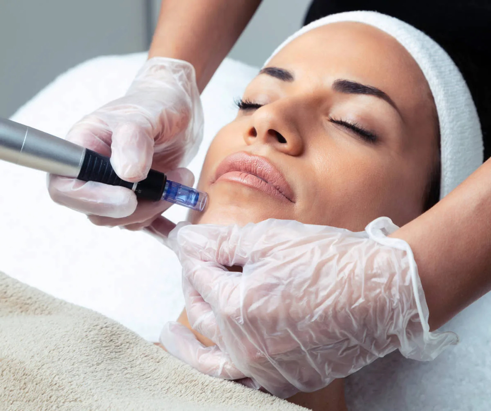 Microneedling at Twilla MedSpa in Fort Smith, AR