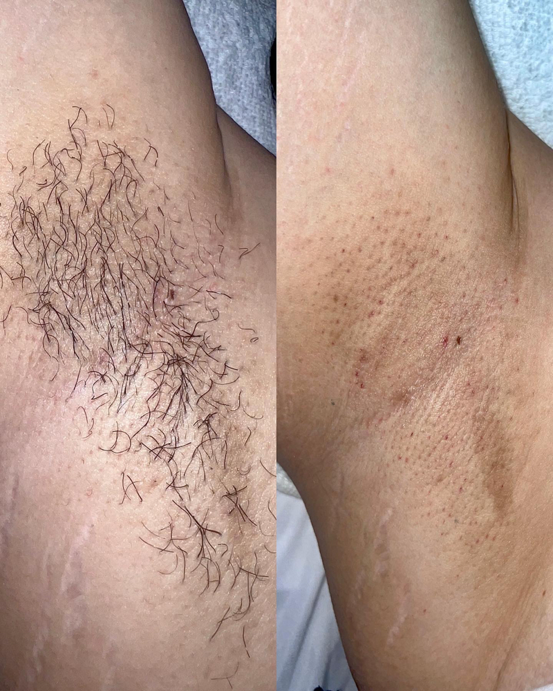 Underarm Wax