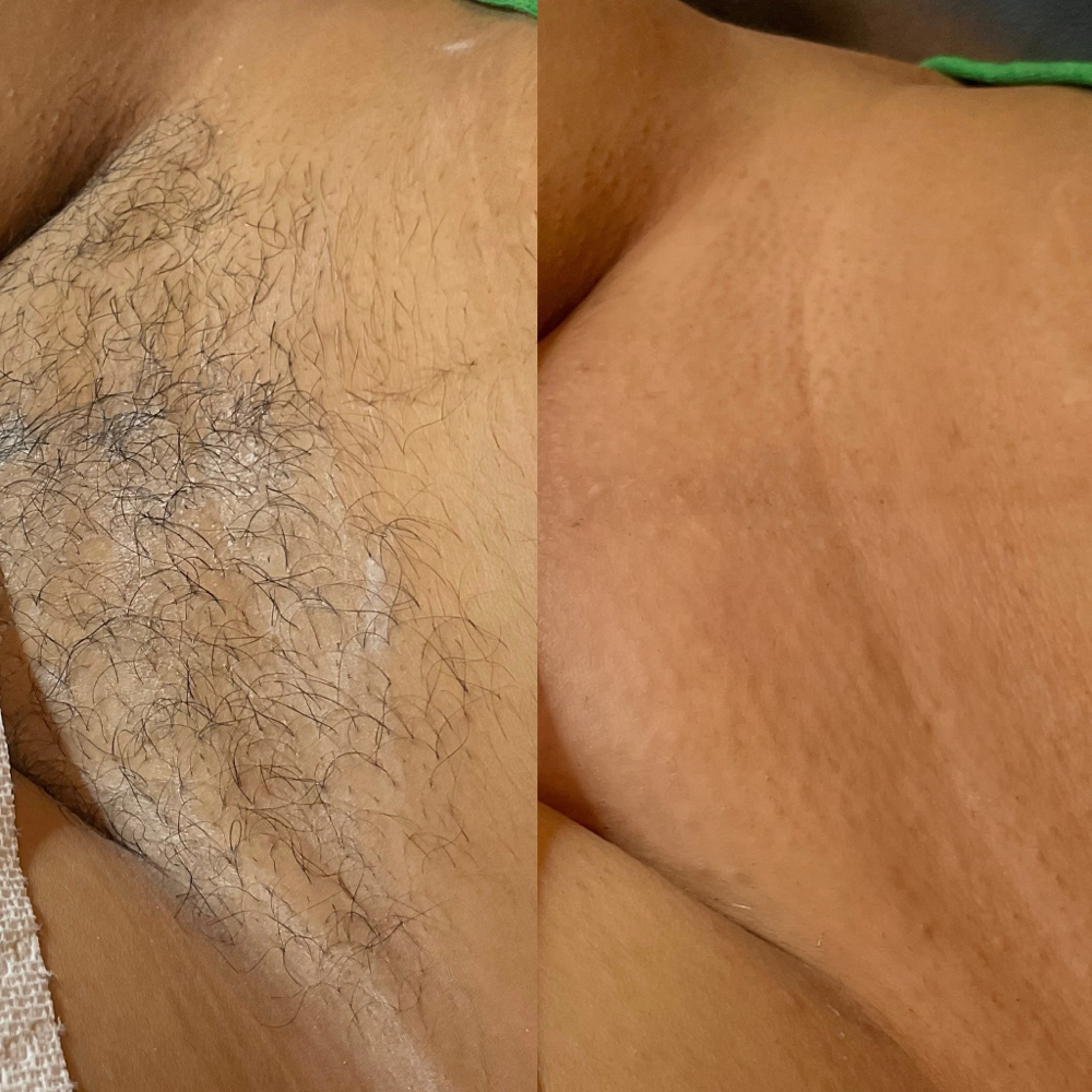 First Time  Brazilian Wax