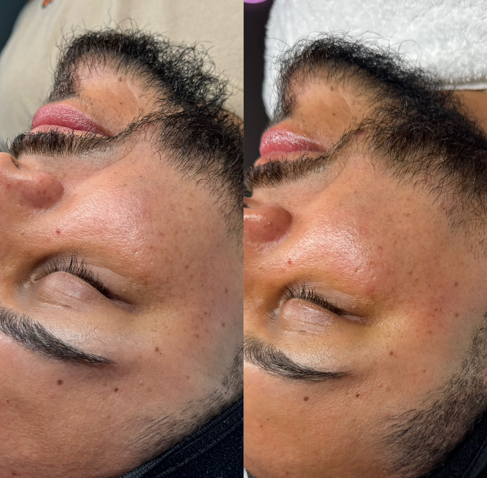 Microderm Brightening Facial