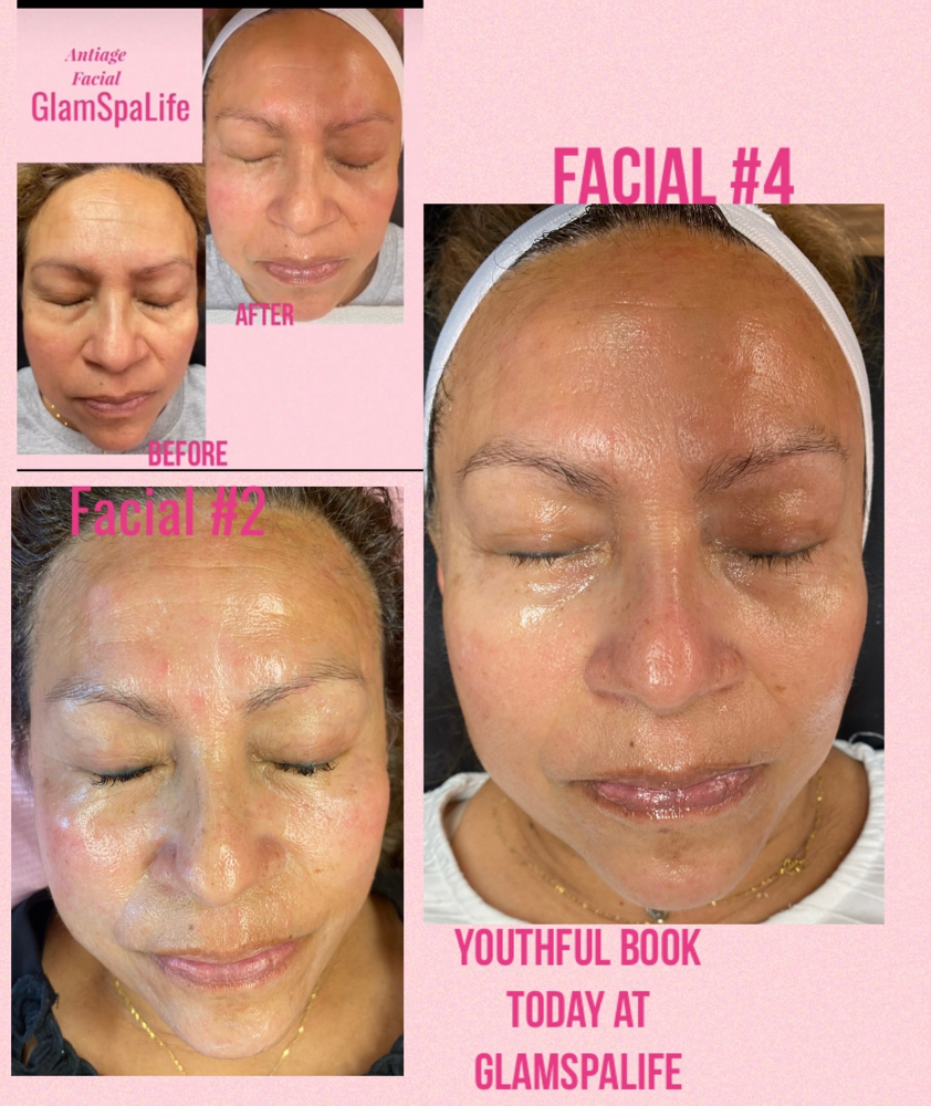 Chemical Peel Facial