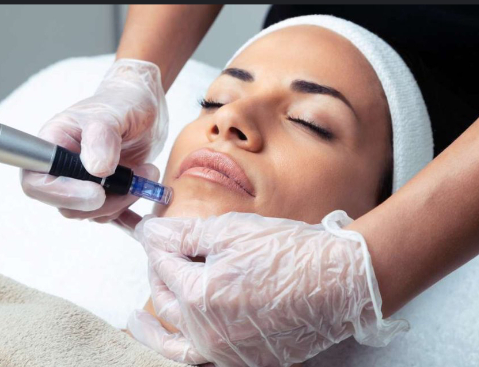 Radio Frequency Microneedling at Signature Skin Spa in Scottsdale, AZ